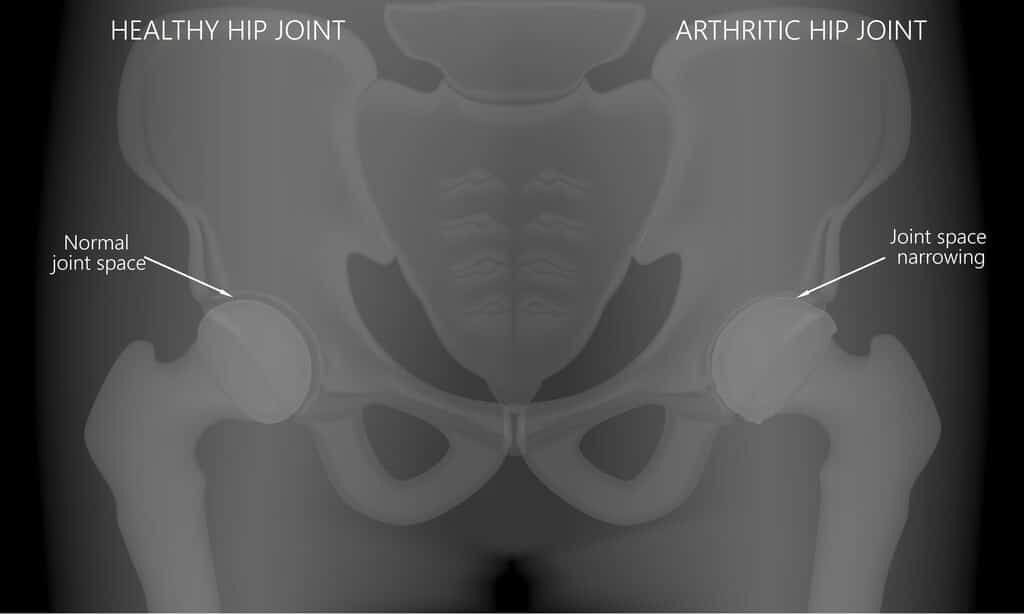 x-ray of human hip joint bones, one side healthy, one side arthritic, labeling joint space narrowing on arthritic side