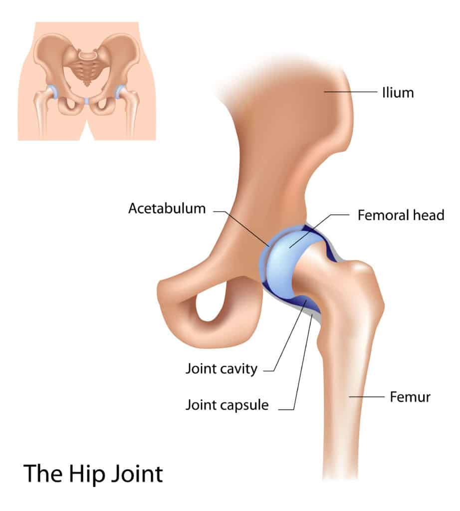 illustration of hip bone with replacement and femur, labeled with parts such as joint cavity