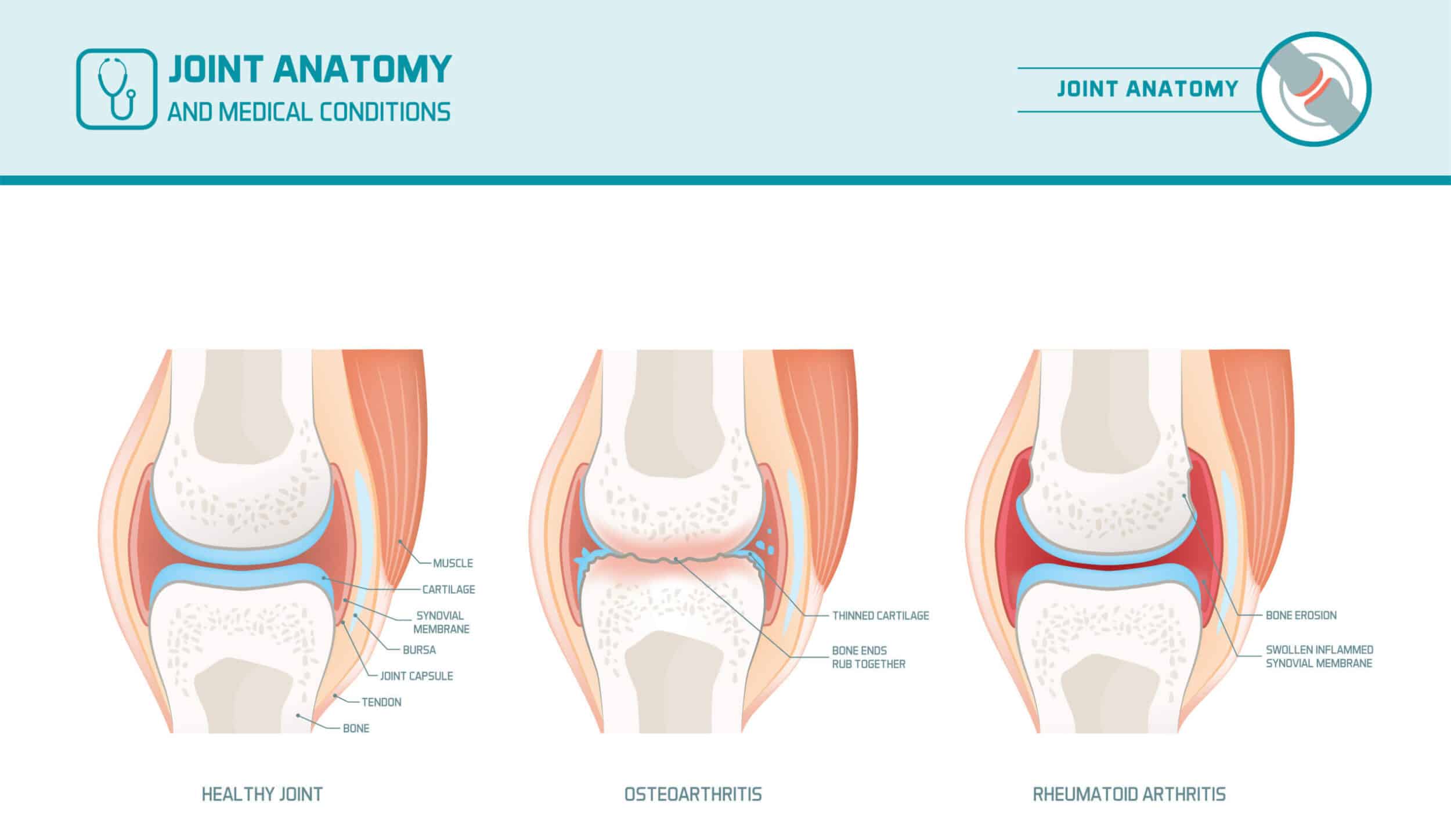 Summit Orthopedics Joint Anatomy