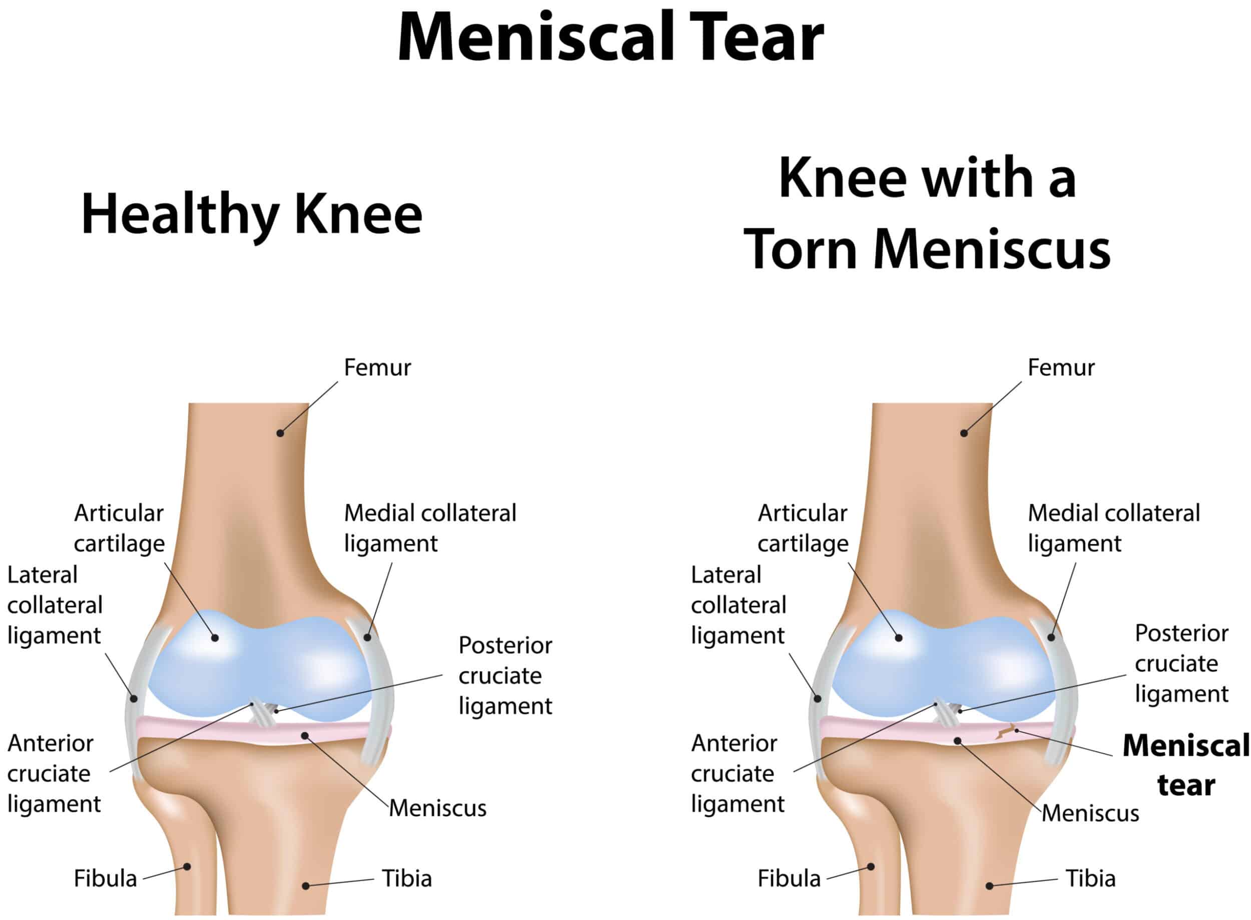 two illustrations of kneecaps side by side, on with meniscal tear