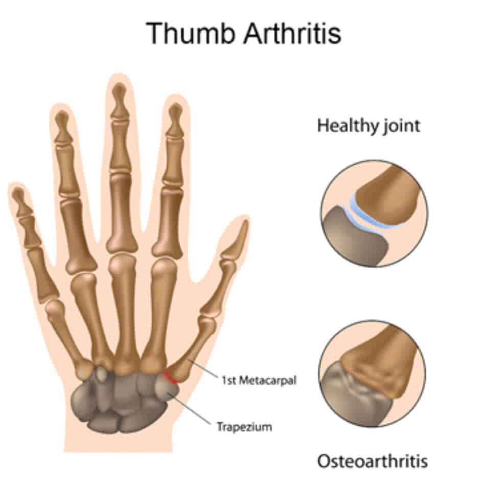 illustration of hand x-ray with parts labeled to represent thumb arthritis