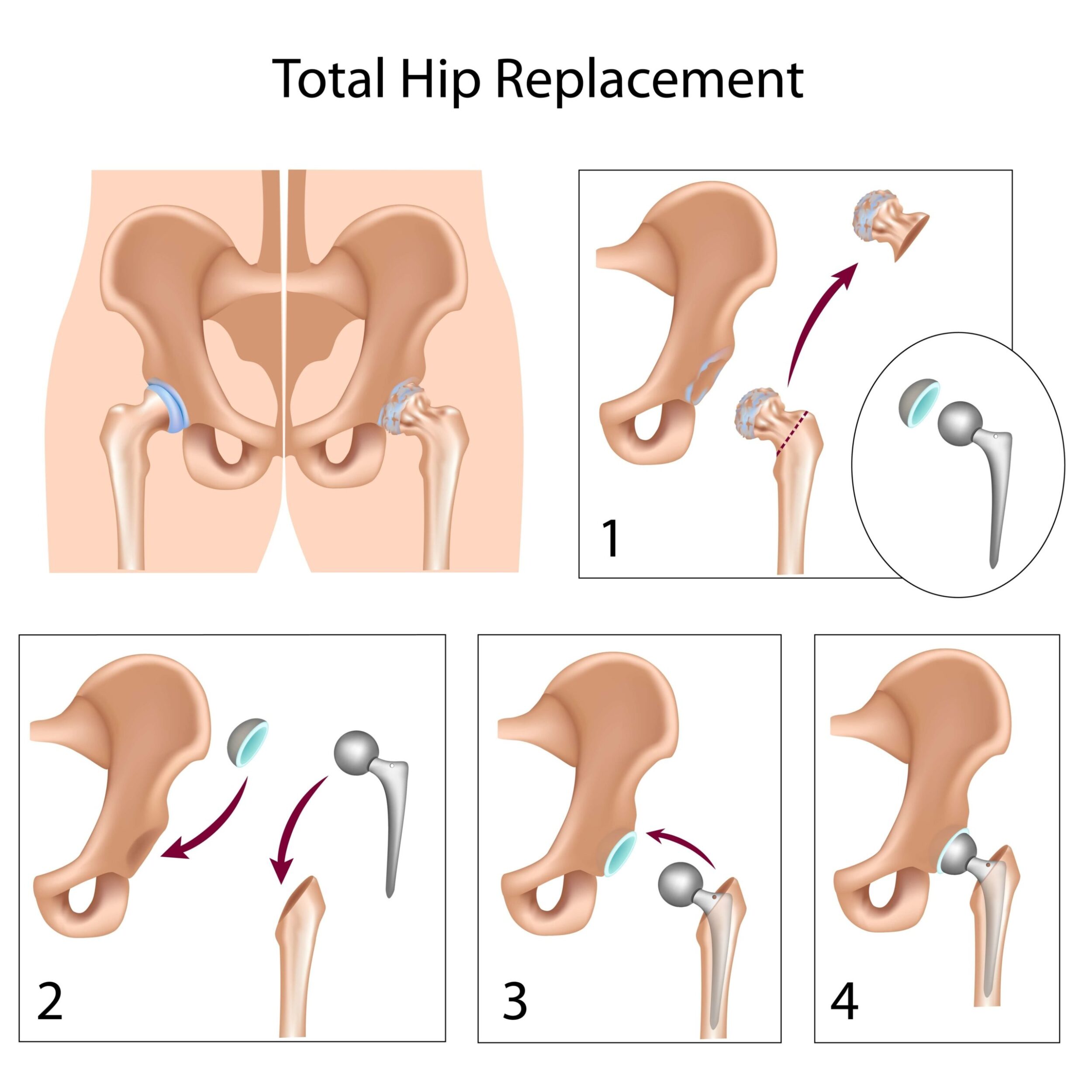Summit Orthopedics Total Hip Replacement scaled