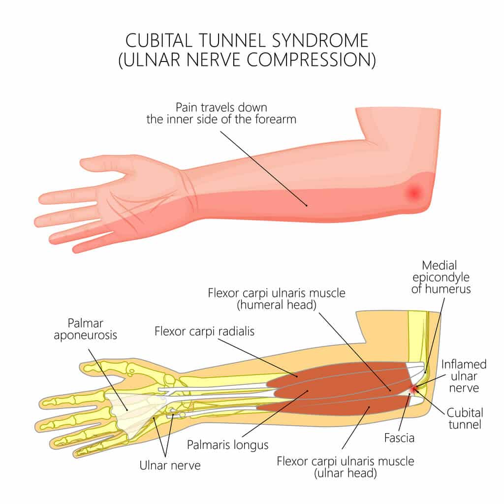 Summit Orthopedics Cubital Tunnel Syndrome