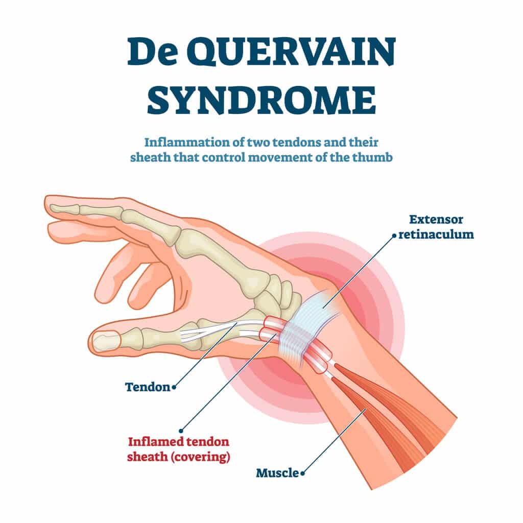 Summit Orthopedics De Quervain Syndrome