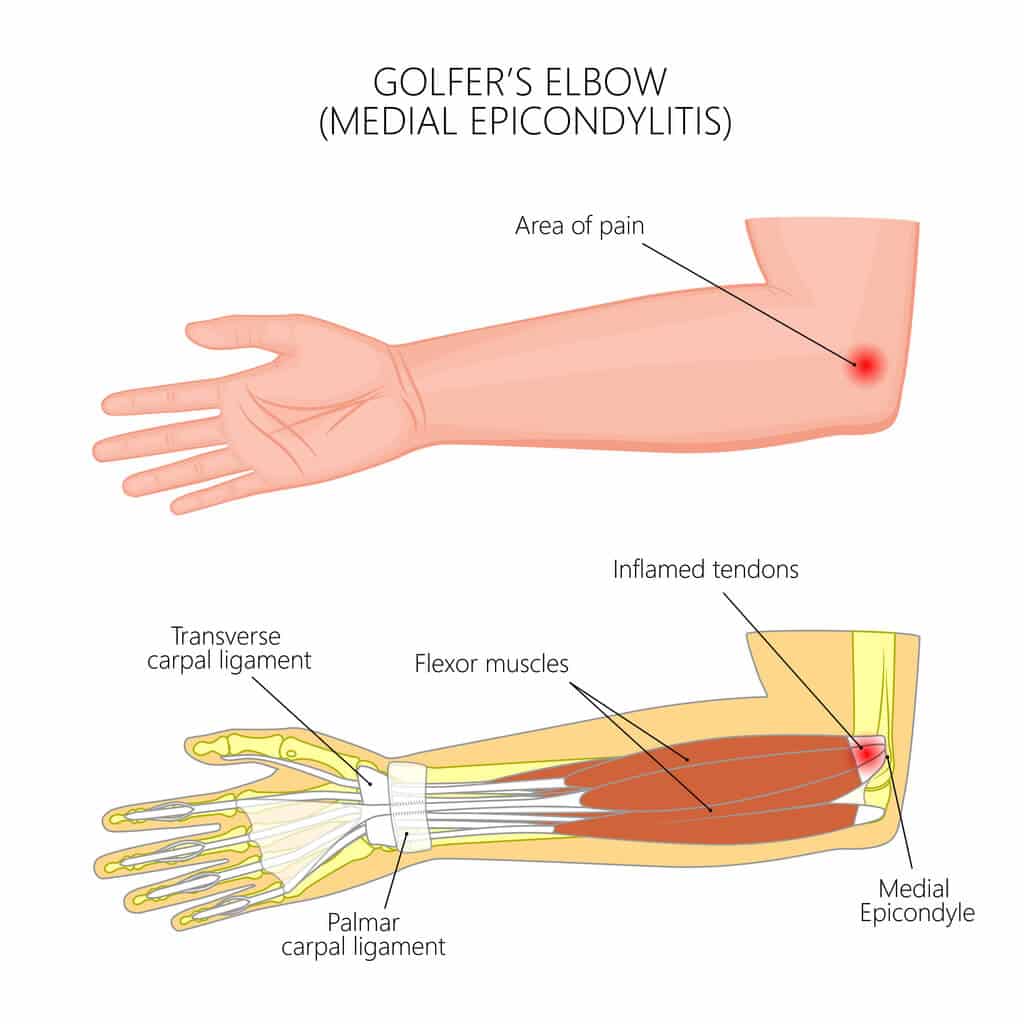 Summit Orthopedics Golfers Elbow