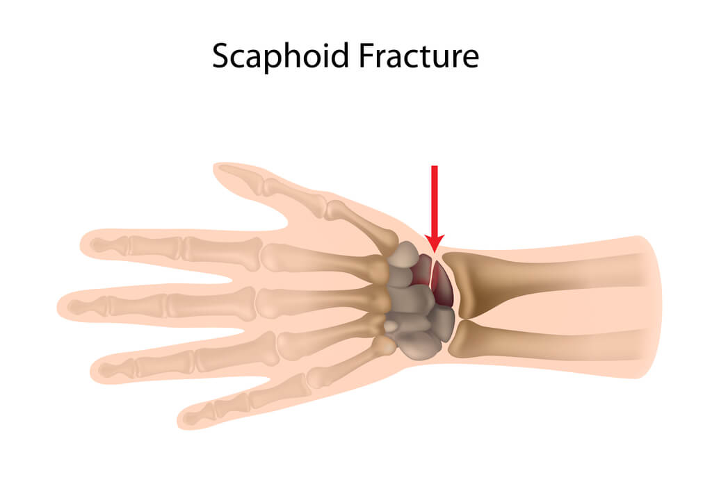 Summit Orthopedics Scaphoid Fracture