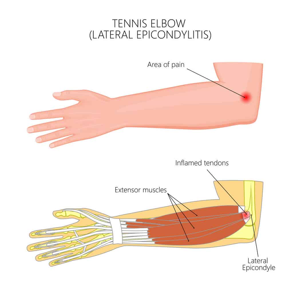 Summit Orthopedics Tennis Elbow