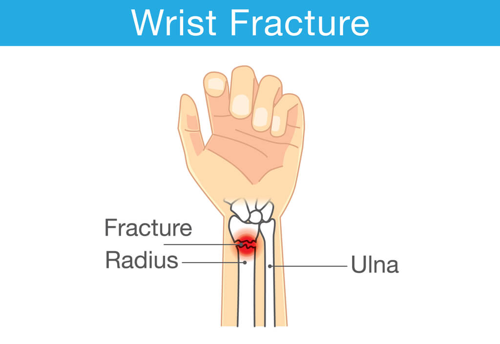 Summit Orthopedics Wrist Fracture