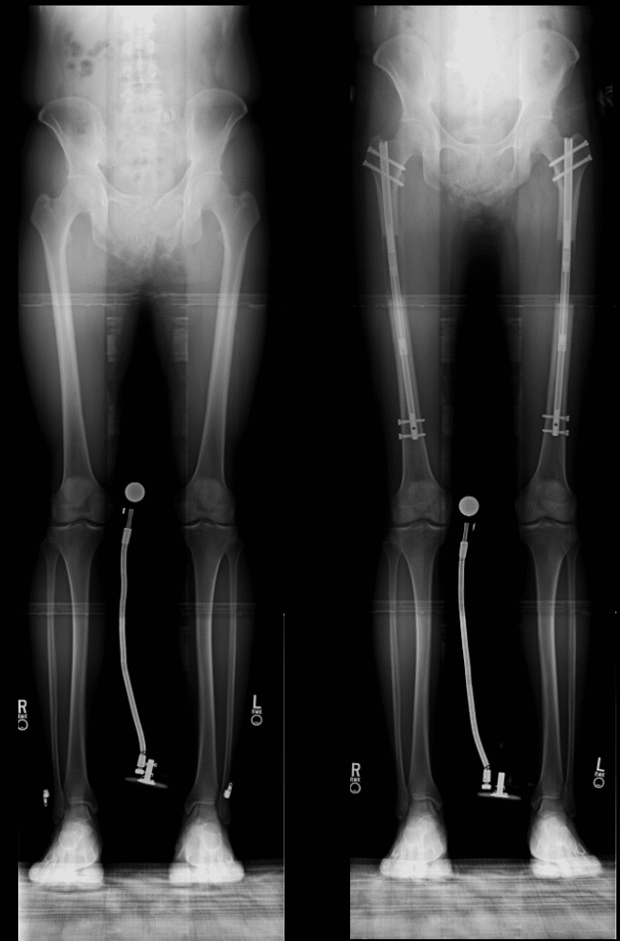 Before and After Image: Limb Lengthening - front